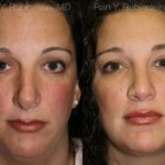 Revision Rhinoplasty Before and After Photos in Newburgh, NY, Patient 13002