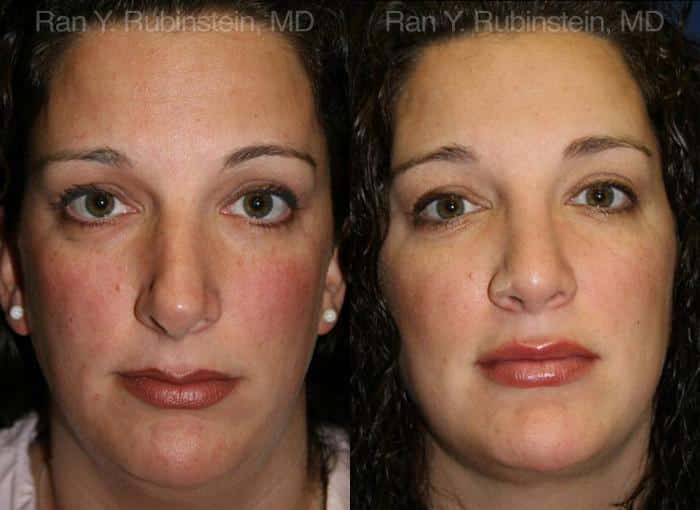 Revision Rhinoplasty Before and After Photos in Newburgh, NY, Patient 13002