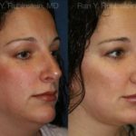 Revision Rhinoplasty Before and After Photos in Newburgh, NY, Patient 13002