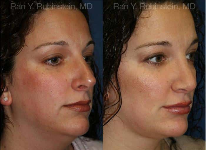 Revision Rhinoplasty Before and After Photos in Newburgh, NY, Patient 13002