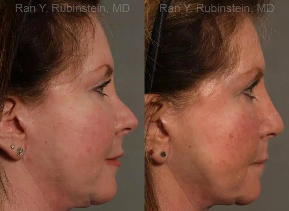 Revision Rhinoplasty Before and After Photos in Newburgh, NY, Patient 13009