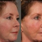 Revision Rhinoplasty Before and After Photos in Newburgh, NY, Patient 13009