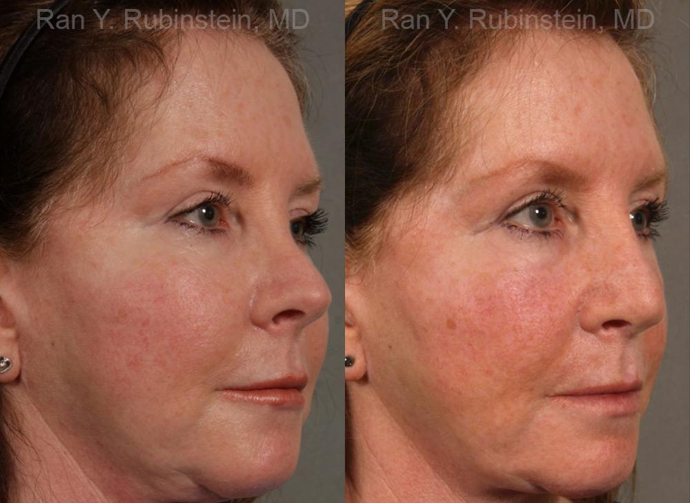 Revision Rhinoplasty Before and After Photos in Newburgh, NY, Patient 13009