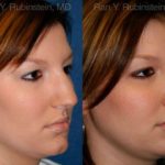 Rhinoplasty Before and After Photos in Newburgh, NY, Patient 13016