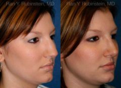 Rhinoplasty Before and After Photos in Newburgh, NY, Patient 13016