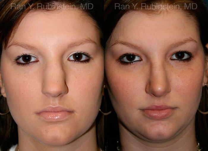 Rhinoplasty Before and After Photos in Newburgh, NY, Patient 13016