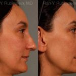 Rhinoplasty Before and After Photos in Newburgh, NY, Patient 13021