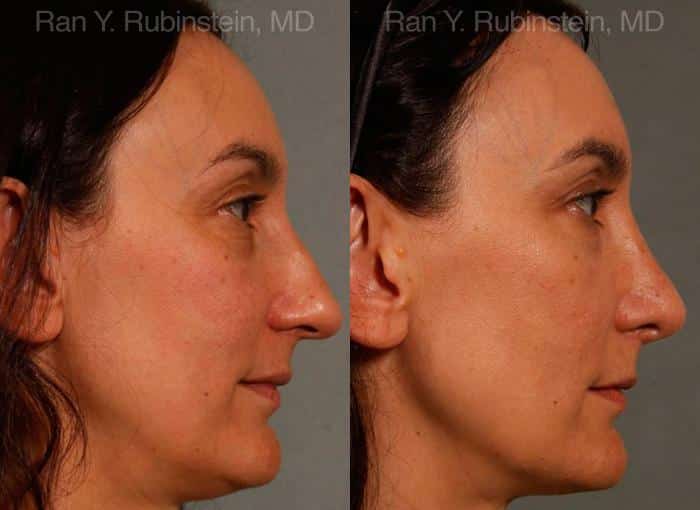 Rhinoplasty Before and After Photos in Newburgh, NY, Patient 13021