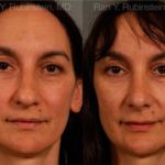 Rhinoplasty Before and After Photos in Newburgh, NY, Patient 13021