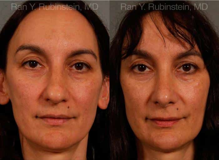 Rhinoplasty Before and After Photos in Newburgh, NY, Patient 13021