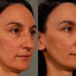 Rhinoplasty Before and After Photos in Newburgh, NY, Patient 13021