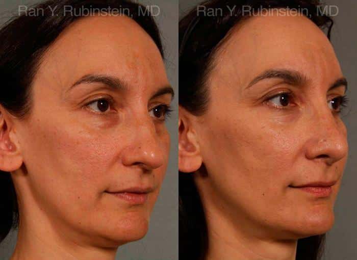 Rhinoplasty Before and After Photos in Newburgh, NY, Patient 13021