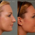 Rhinoplasty Before and After Photos in Newburgh, NY, Patient 13028