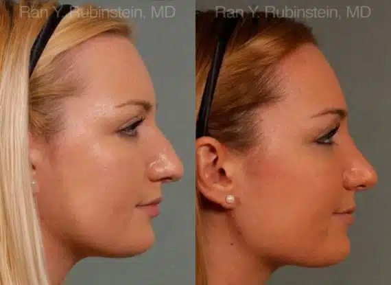 Rhinoplasty Before and After Photos in Newburgh, NY, Patient 13028