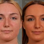 Rhinoplasty Before and After Photos in Newburgh, NY, Patient 13028