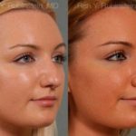 Rhinoplasty Before and After Photos in Newburgh, NY, Patient 13028