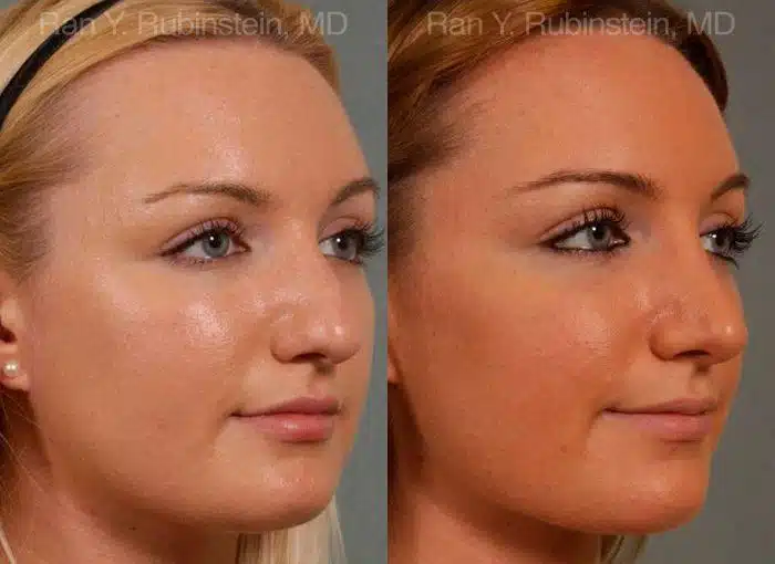 Rhinoplasty Before and After Photos in Newburgh, NY, Patient 13028