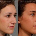 Rhinoplasty Before and After Photos in Newburgh, NY, Patient 13035