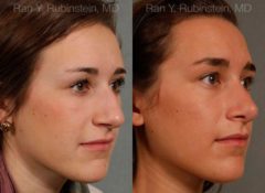 Rhinoplasty Before and After Photos in Newburgh, NY, Patient 13035