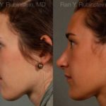 Rhinoplasty Before and After Photos in Newburgh, NY, Patient 13035