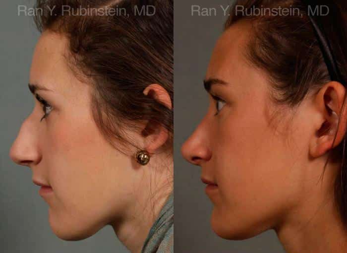 Rhinoplasty Before and After Photos in Newburgh, NY, Patient 13035