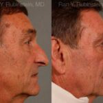 Rhinoplasty Before and After Photos in Newburgh, NY, Patient 13040