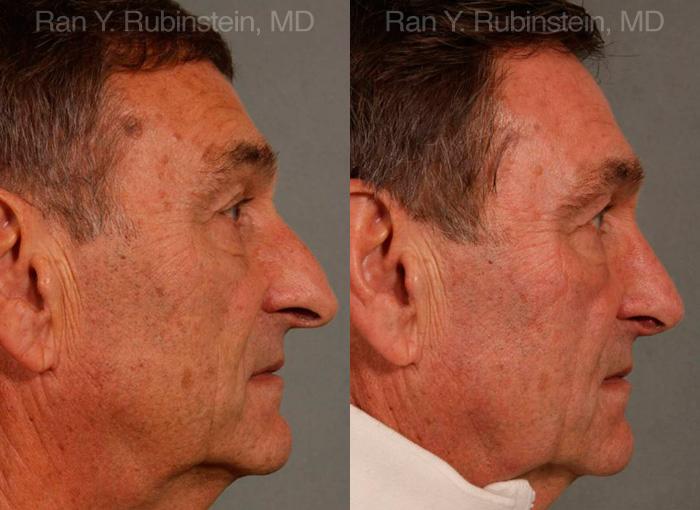 Rhinoplasty Before and After Photos in Newburgh, NY, Patient 13040