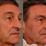 Rhinoplasty Before and After Photos in Newburgh, NY, Patient 13040