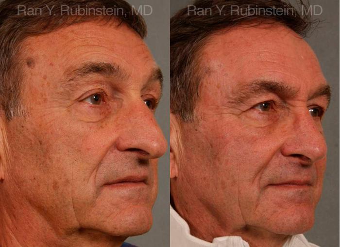 Rhinoplasty Before and After Photos in Newburgh, NY, Patient 13040