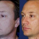 Rhinoplasty Before and After Photos in Newburgh, NY, Patient 13047