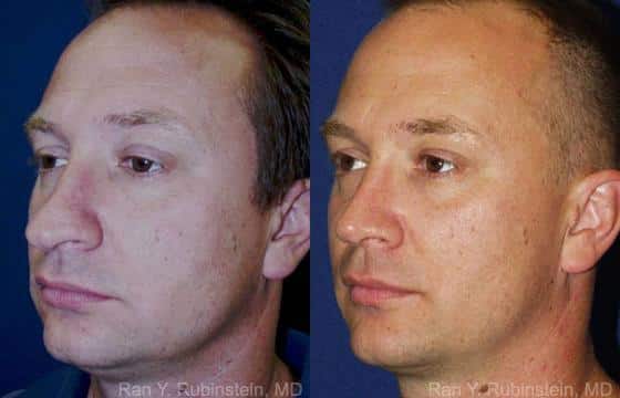 Rhinoplasty Before and After Photos in Newburgh, NY, Patient 13047