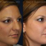 Rhinoplasty Before and After Photos in Newburgh, NY, Patient 13062