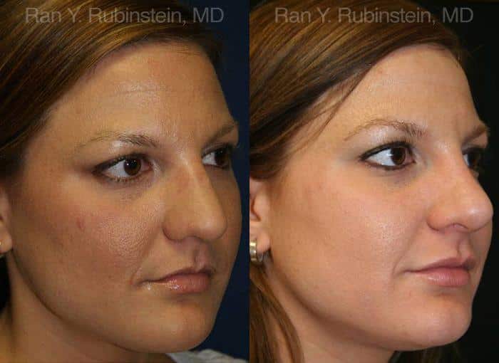 Rhinoplasty Before and After Photos in Newburgh, NY, Patient 13062