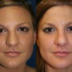 Rhinoplasty Before and After Photos in Newburgh, NY, Patient 13062