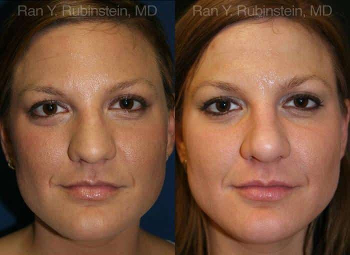 Rhinoplasty Before and After Photos in Newburgh, NY, Patient 13062