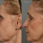 Rhinoplasty Before and After Photos in Newburgh, NY, Patient 13067