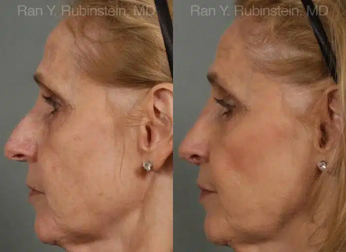 Rhinoplasty Before and After Photos in Newburgh, NY, Patient 13067