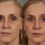 Rhinoplasty Before and After Photos in Newburgh, NY, Patient 13067