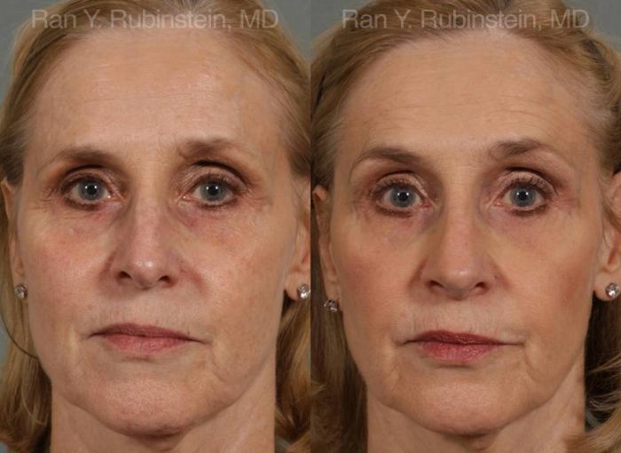 Rhinoplasty Before and After Photos in Newburgh, NY, Patient 13067