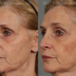 Rhinoplasty Before and After Photos in Newburgh, NY, Patient 13067