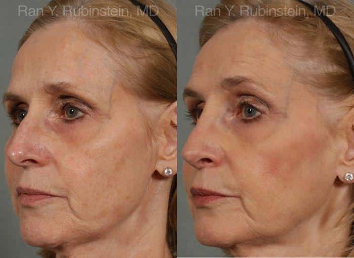 Rhinoplasty Before and After Photos in Newburgh, NY, Patient 13067