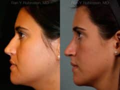 Rhinoplasty Before and After Photos in Newburgh, NY, Patient 13084