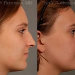 Rhinoplasty Before and After Photos in Newburgh, NY, Patient 13091