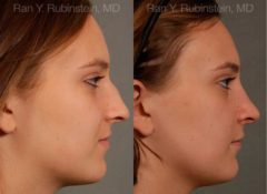 Rhinoplasty Before and After Photos in Newburgh, NY, Patient 13091