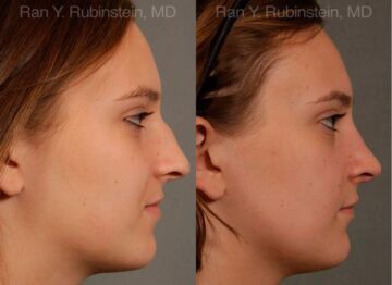 Rhinoplasty Before and After Photos in Montvale, NJ, Patient 13091