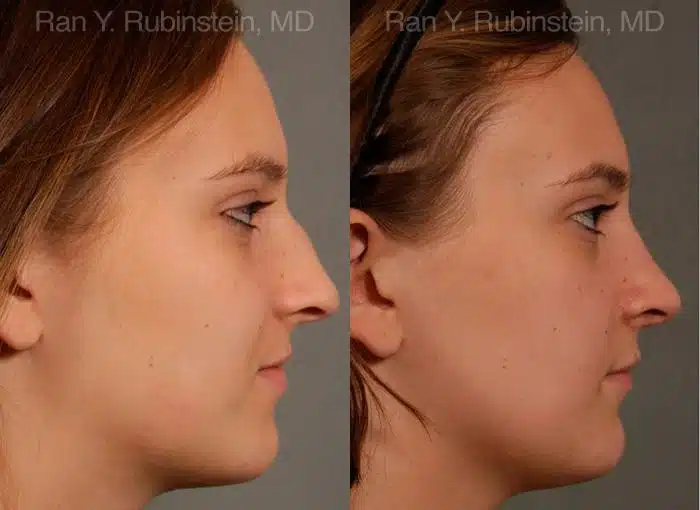 Rhinoplasty Before and After Photos in Newburgh, NY, Patient 13091