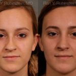 Rhinoplasty Before and After Photos in Newburgh, NY, Patient 13091