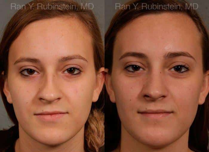 Rhinoplasty Before and After Photos in Newburgh, NY, Patient 13091