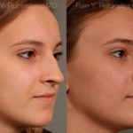 Rhinoplasty Before and After Photos in Newburgh, NY, Patient 13091