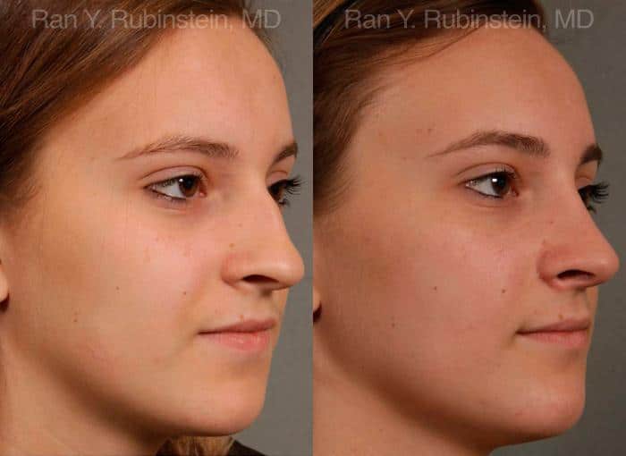 Rhinoplasty Before and After Photos in Newburgh, NY, Patient 13091